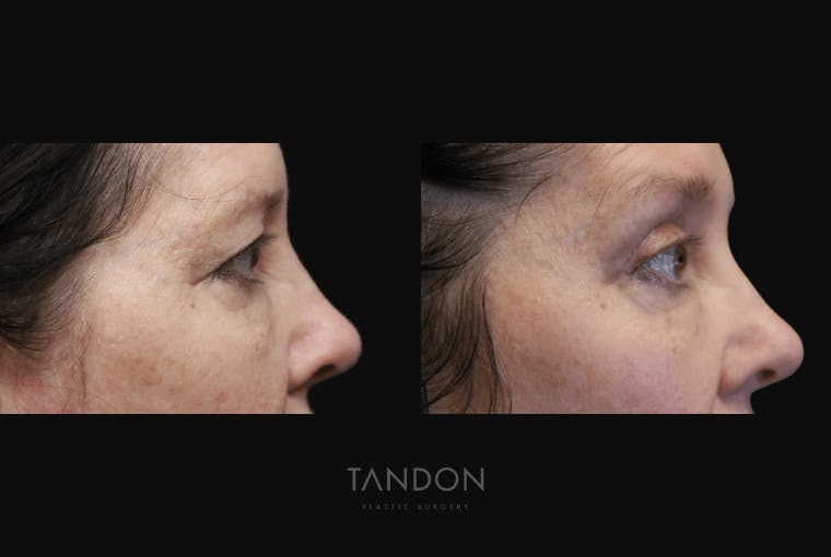 Blepharoplasty Before & After Gallery - Patient 320547 - Image 2