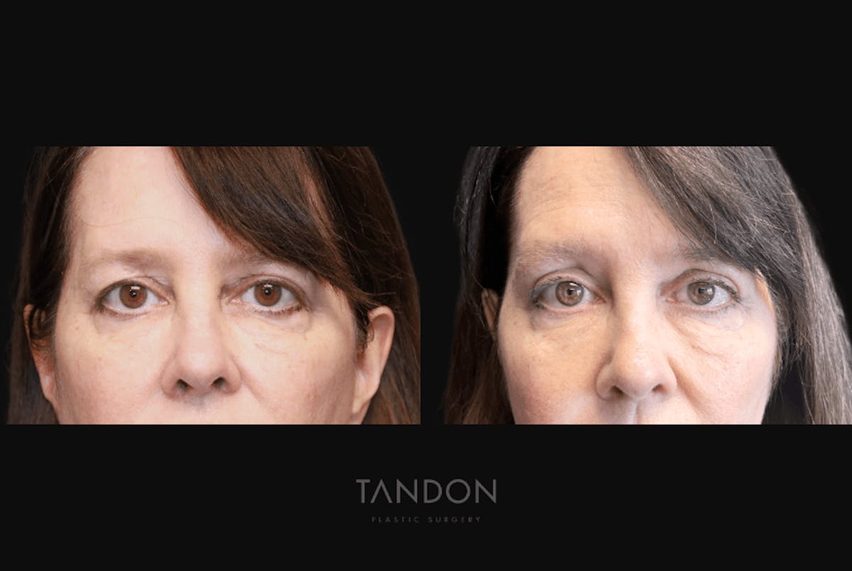 Blepharoplasty Before & After Gallery - Patient 320547 - Image 1