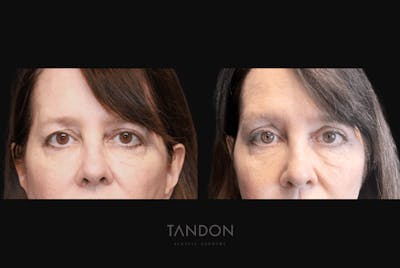 Blepharoplasty Before & After Gallery - Patient 320547 - Image 1