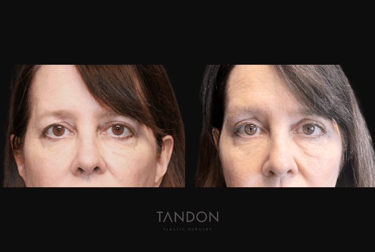 Blepharoplasty Before & After Gallery - Patient 320547 - Image 1