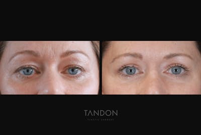 Blepharoplasty Before & After Gallery - Patient 101876 - Image 1