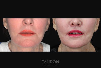 Lip Lift Before & After Gallery - Patient 173781 - Image 1