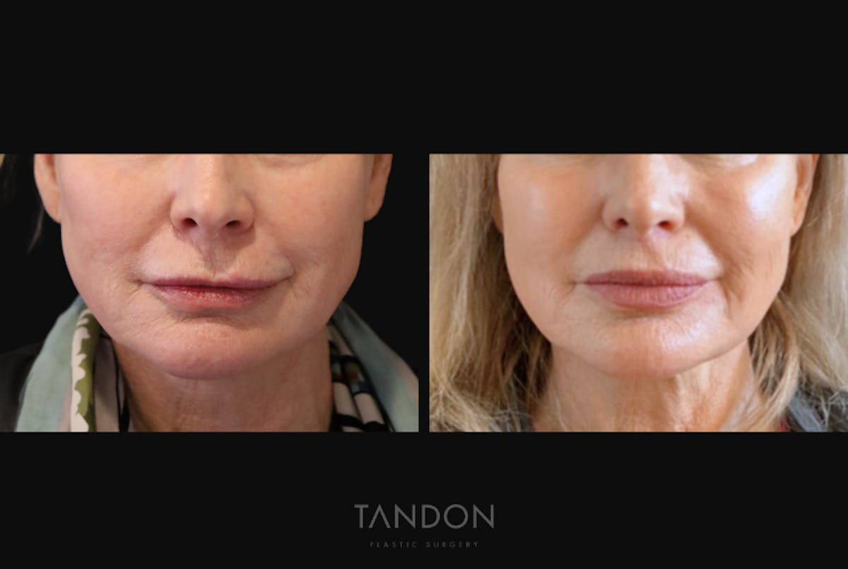 Lip Lift Before & After Gallery - Patient 413087 - Image 1