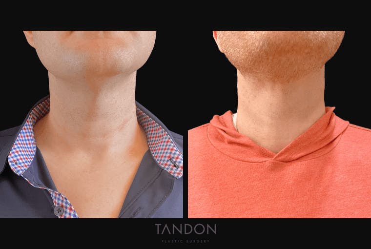 Neck Lift Before & After Gallery - Patient 291565 - Image 2