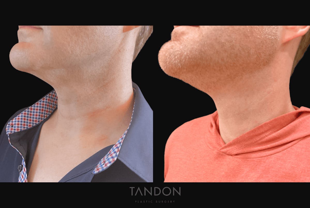 Neck Lift Before & After Gallery - Patient 291565 - Image 1