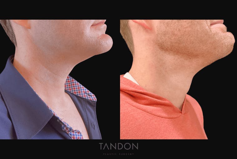Neck Lift Before & After Gallery - Patient 291565 - Image 3