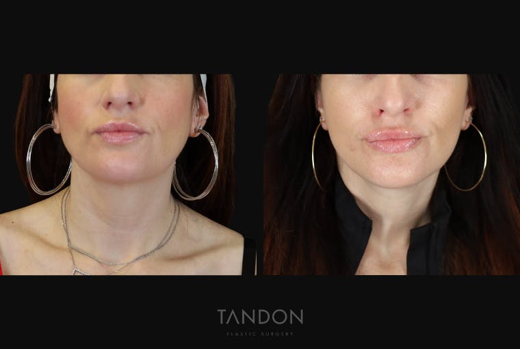 Neck Lift Before & After Gallery - Patient 203680 - Image 3