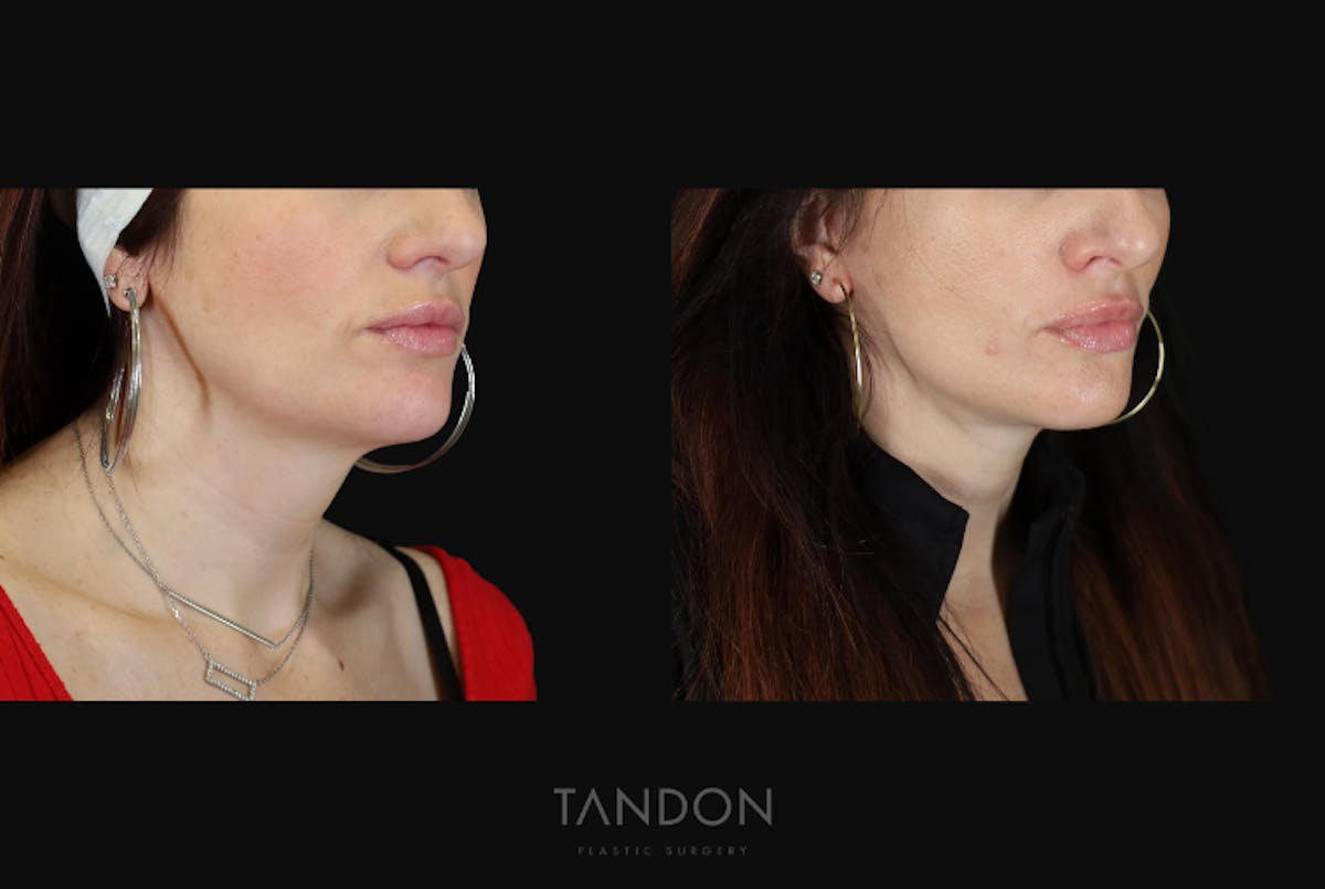 Neck Lift Before & After Gallery - Patient 203680 - Image 2