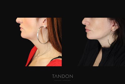 Neck Lift Before & After Gallery - Patient 203680 - Image 1