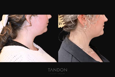 Neck Liposuction Before & After Gallery - Patient 361828 - Image 1
