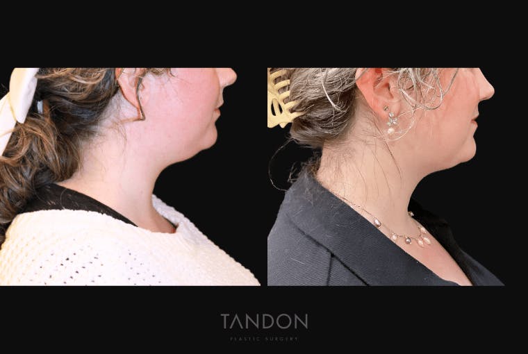 Neck Liposuction Before & After Gallery - Patient 361828 - Image 1