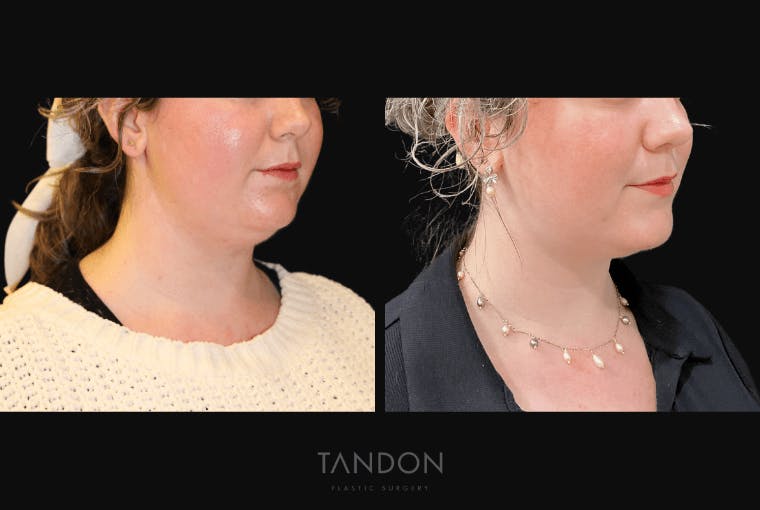 Neck Liposuction Before & After Gallery - Patient 361828 - Image 4