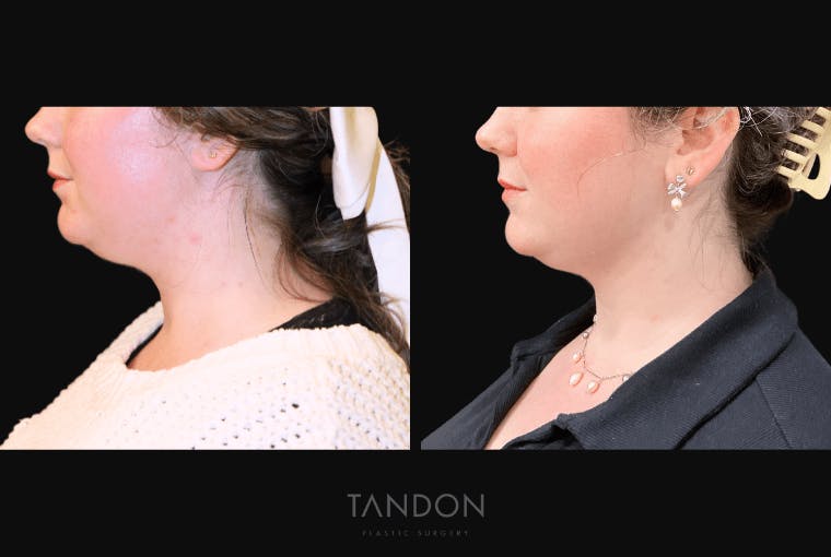 Neck Liposuction Before & After Gallery - Patient 361828 - Image 3