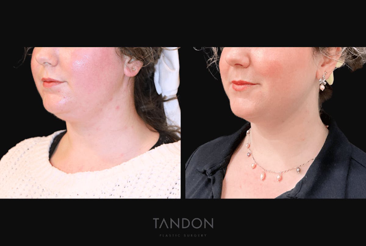 Neck Liposuction Before & After Gallery - Patient 361828 - Image 2