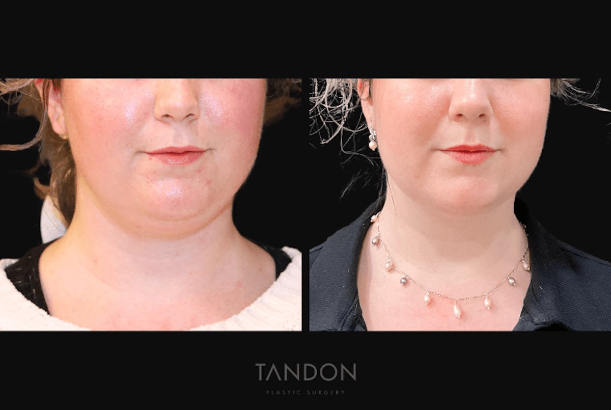 Neck Liposuction Before & After Gallery - Patient 361828 - Image 5