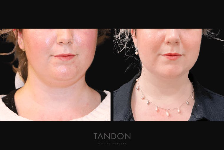 Neck Liposuction Before & After Gallery - Patient 361828 - Image 5