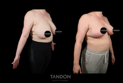 Breast Reduction Before & After Gallery - Patient 357504 - Image 2