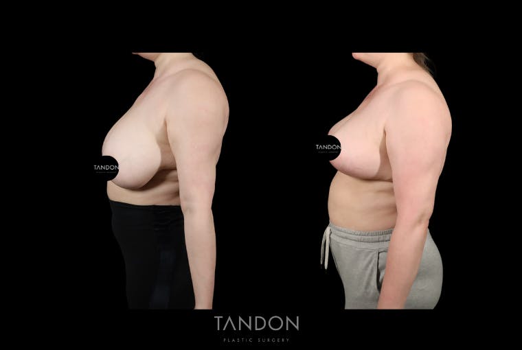 Liposuction Before & After Gallery - Patient 384243 - Image 3