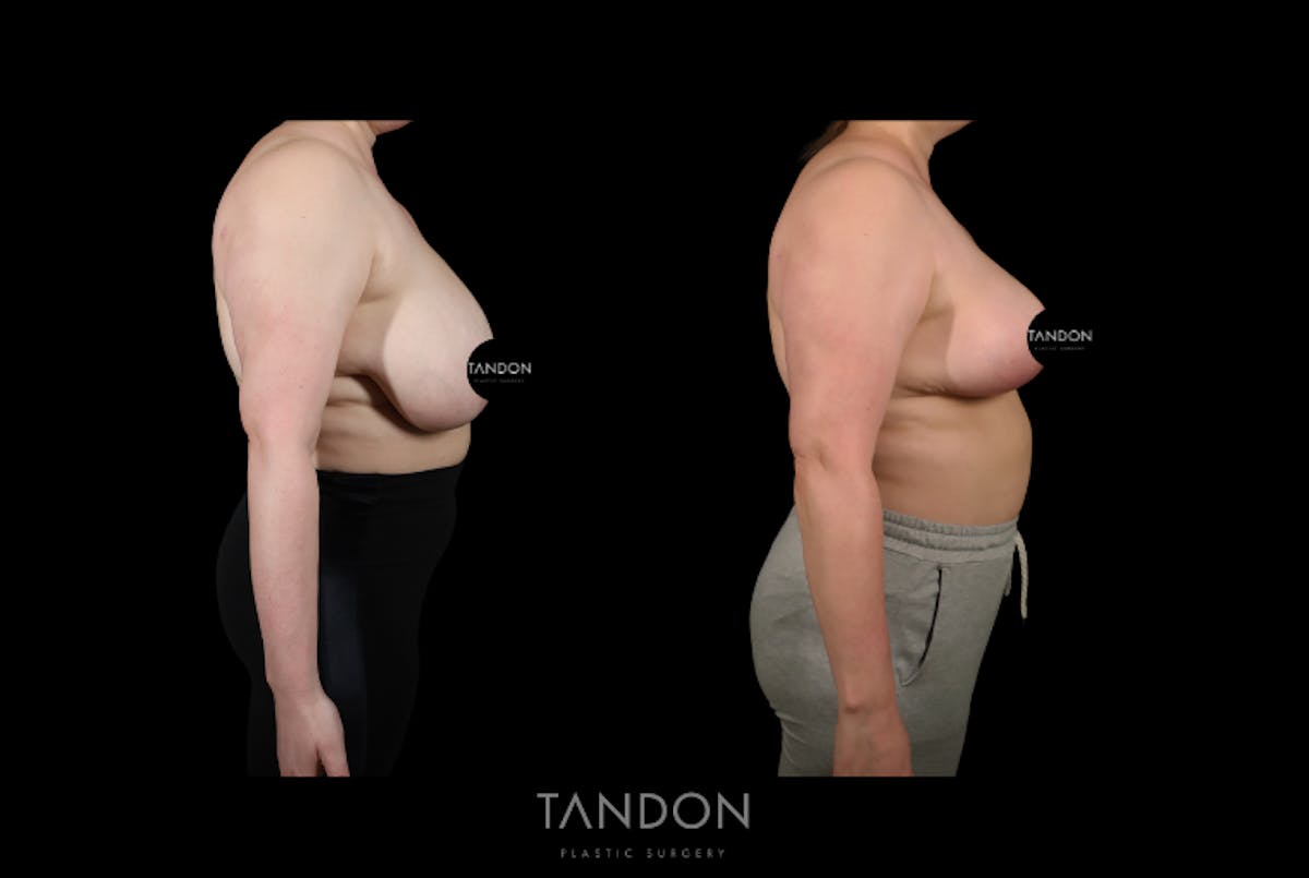 Breast Reduction Before & After Gallery - Patient 357504 - Image 4