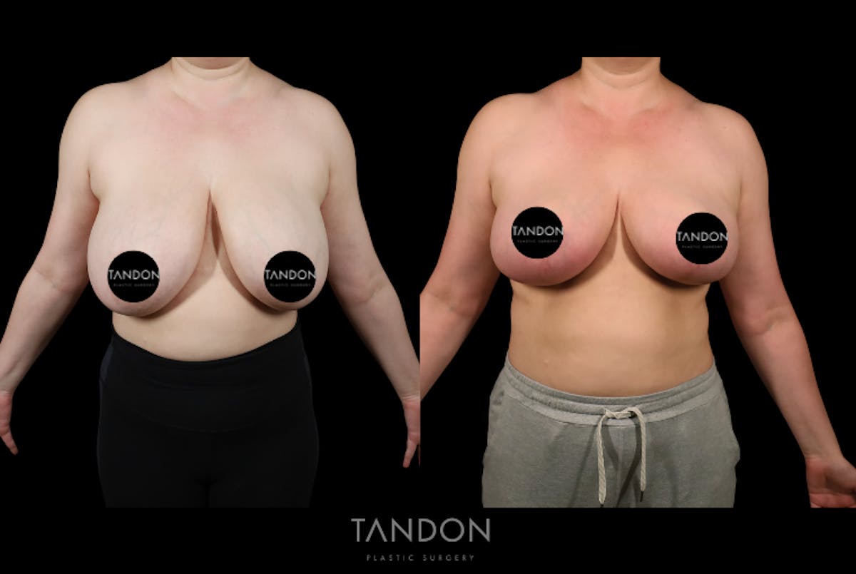 Breast Reduction Before & After Gallery - Patient 357504 - Image 1