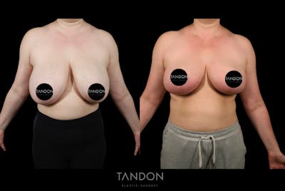 Liposuction Before & After Gallery - Patient 384243 - Image 1