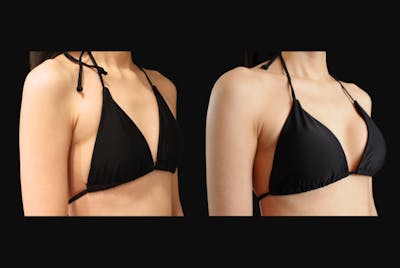 Breast Augmentation Before & After Gallery - Patient 361893 - Image 1