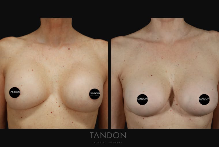 Breast Implant Exchange Before & After Gallery - Patient 288503 - Image 2