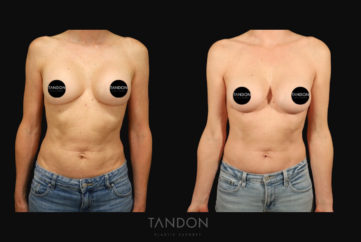 Breast Revision Before & After Gallery - Patient 309524 - Image 1