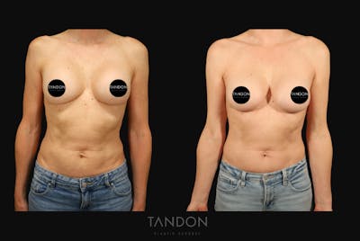 Breast Implant Exchange Before & After Gallery - Patient 288503 - Image 1