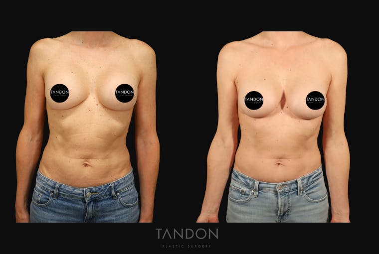 Breast Implant Exchange Before & After Gallery - Patient 288503 - Image 1