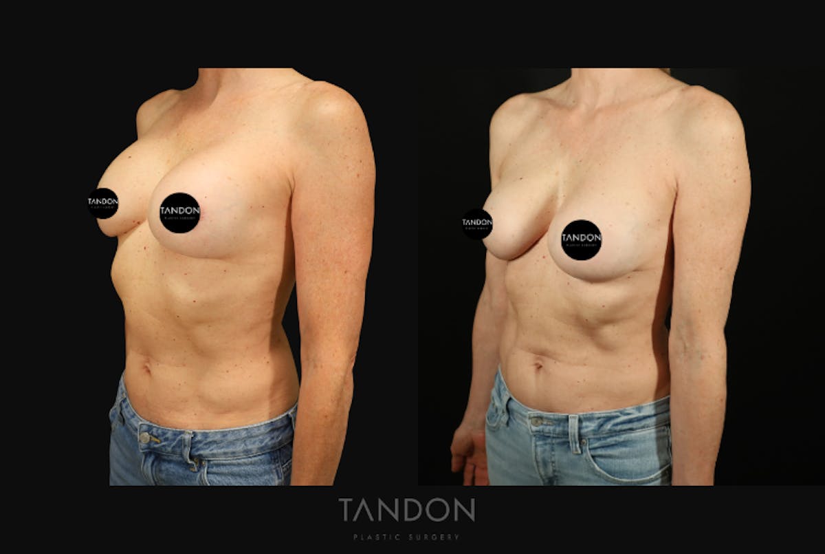 Breast Revision Before & After Gallery - Patient 309524 - Image 5
