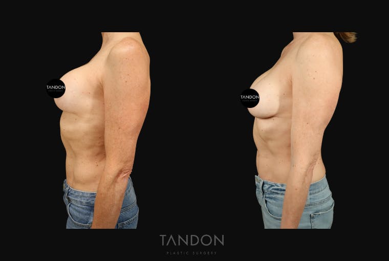 Breast Implant Exchange Before & After Gallery - Patient 288503 - Image 4