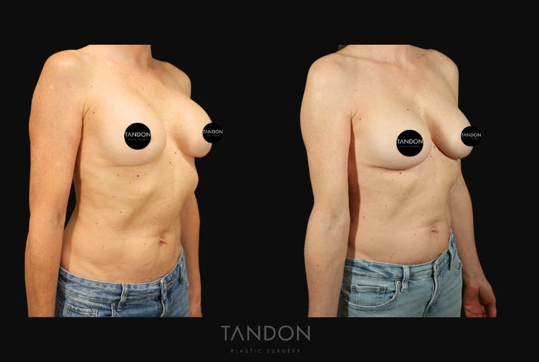 Breast Implant Exchange Before & After Gallery - Patient 288503 - Image 3
