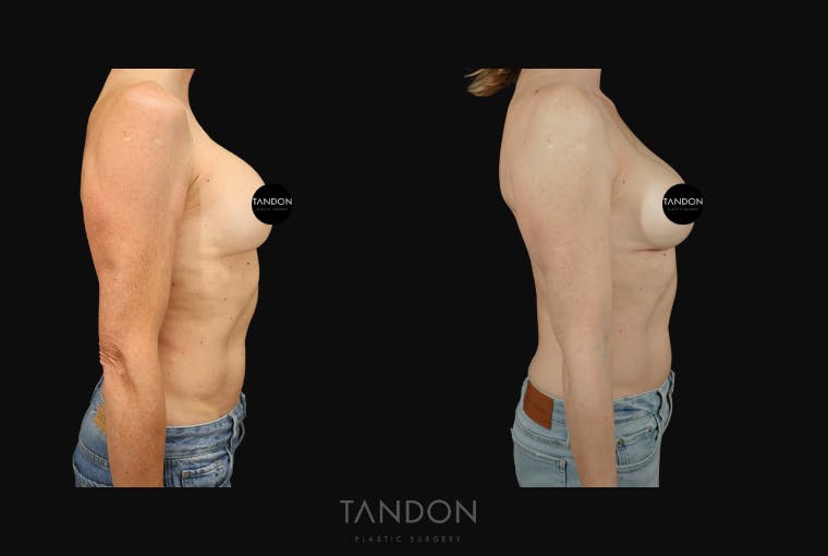 Breast Implant Exchange Before & After Gallery - Patient 288503 - Image 6