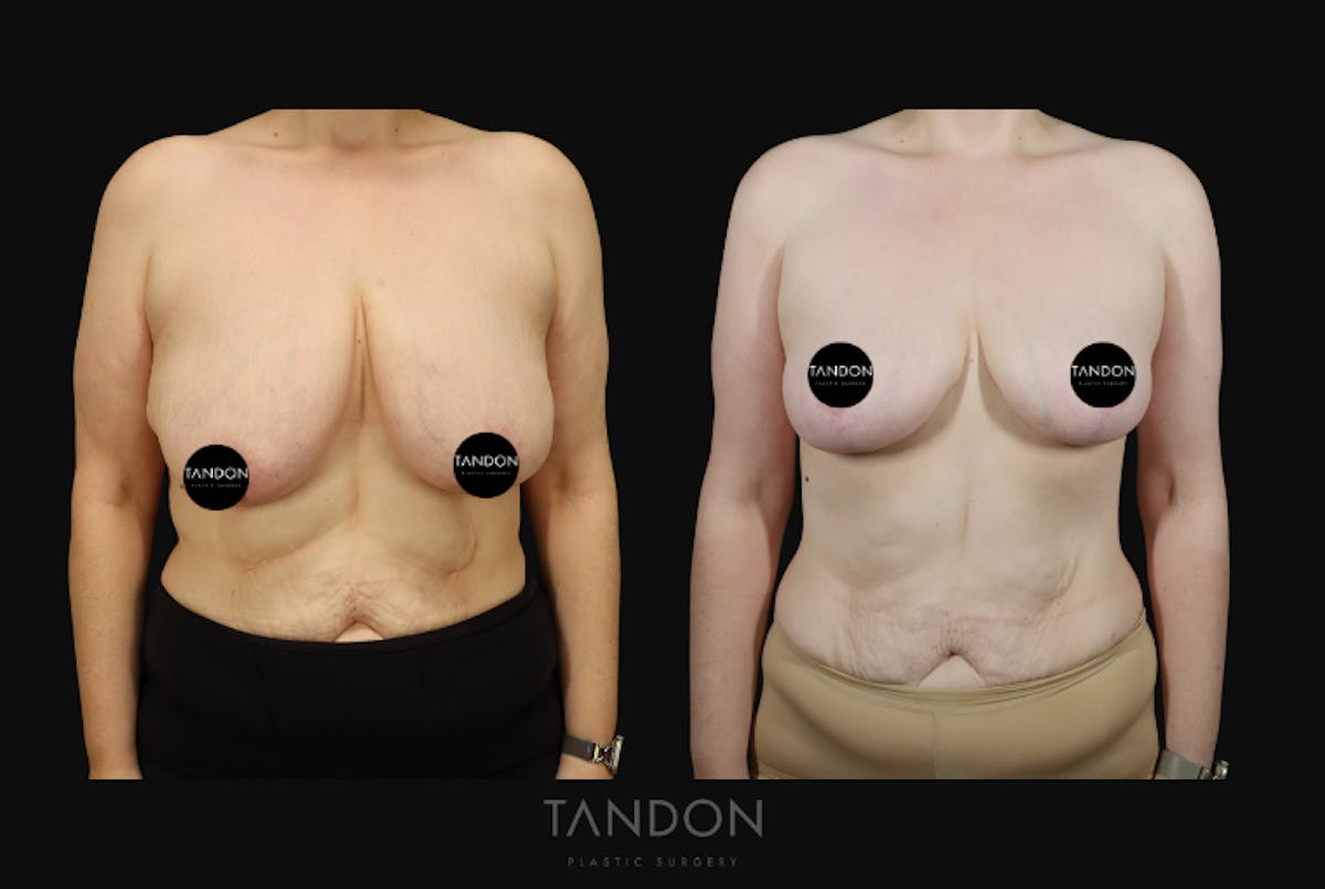 Breast Lift Before & After Gallery - Patient 274004 - Image 1