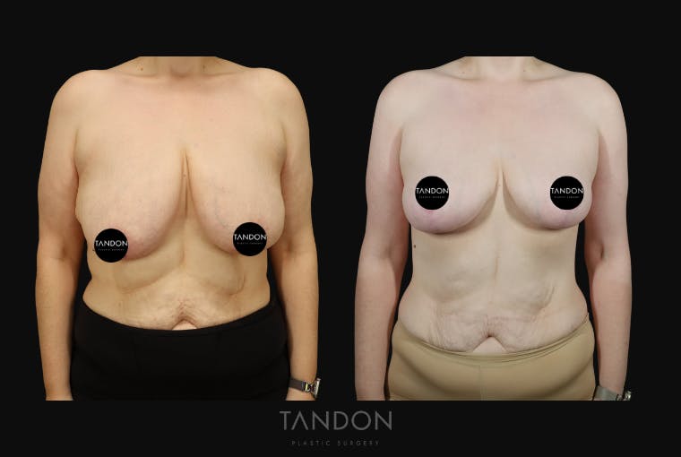 Breast Lift Before & After Gallery - Patient 274004 - Image 1