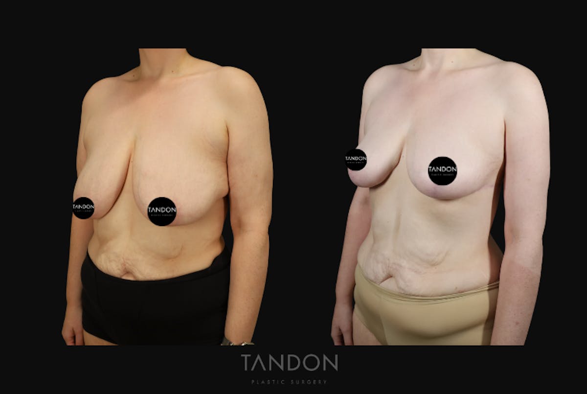 Breast Lift Before & After Gallery - Patient 274004 - Image 5