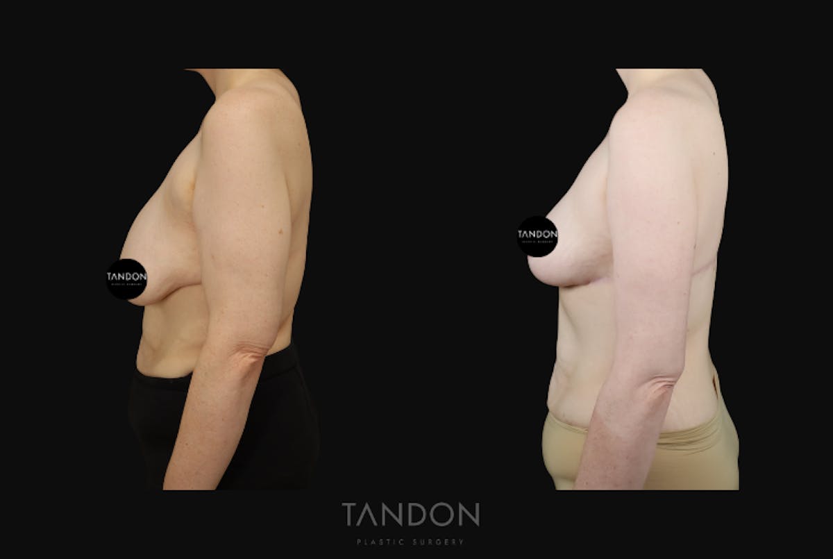 Breast Lift Before & After Gallery - Patient 274004 - Image 4