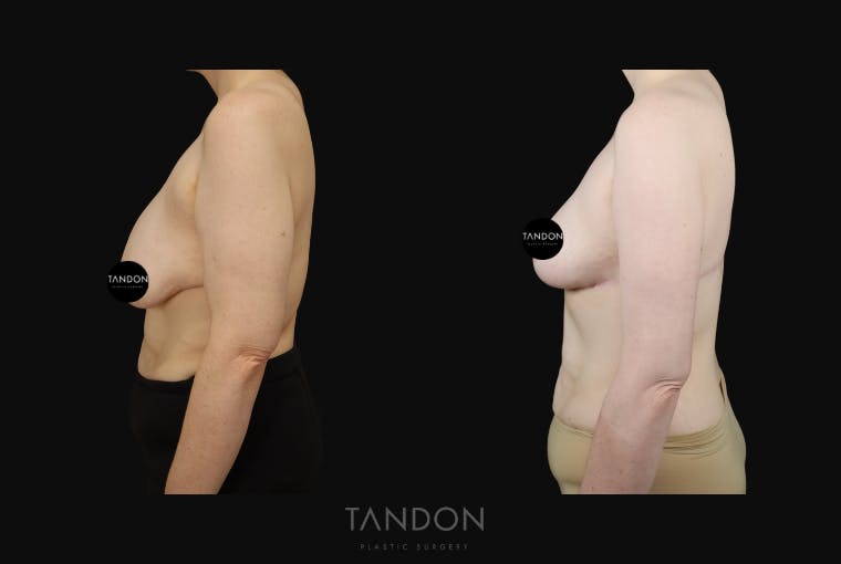 Breast Lift Before & After Gallery - Patient 274004 - Image 4