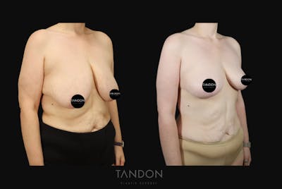 Breast Lift Before & After Gallery - Patient 274004 - Image 2