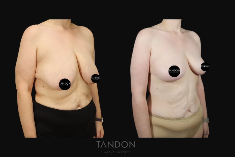 Breast Lift Before & After Gallery - Patient 274004 - Image 2