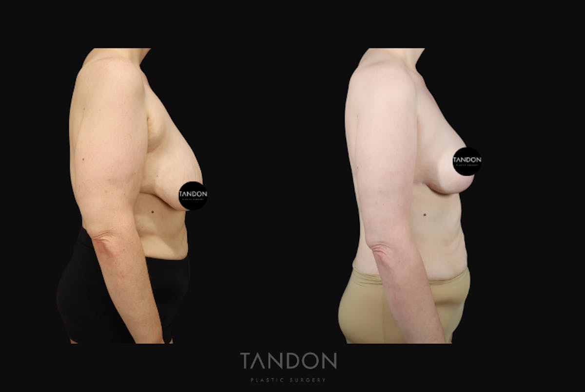 Breast Lift Before & After Gallery - Patient 274004 - Image 3