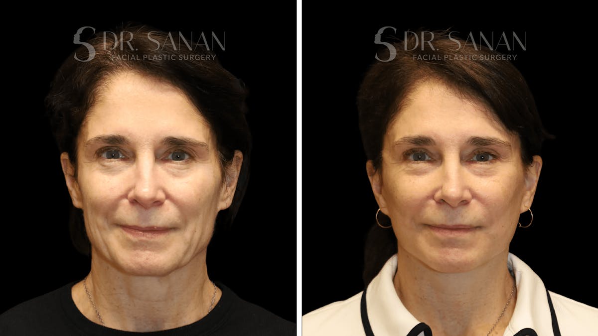 Brow Lift Before & After Gallery - Patient 422921 - Image 1