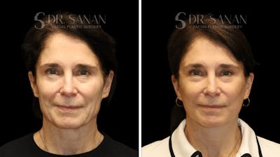 Brow Lift Before & After Gallery - Patient 422921 - Image 1