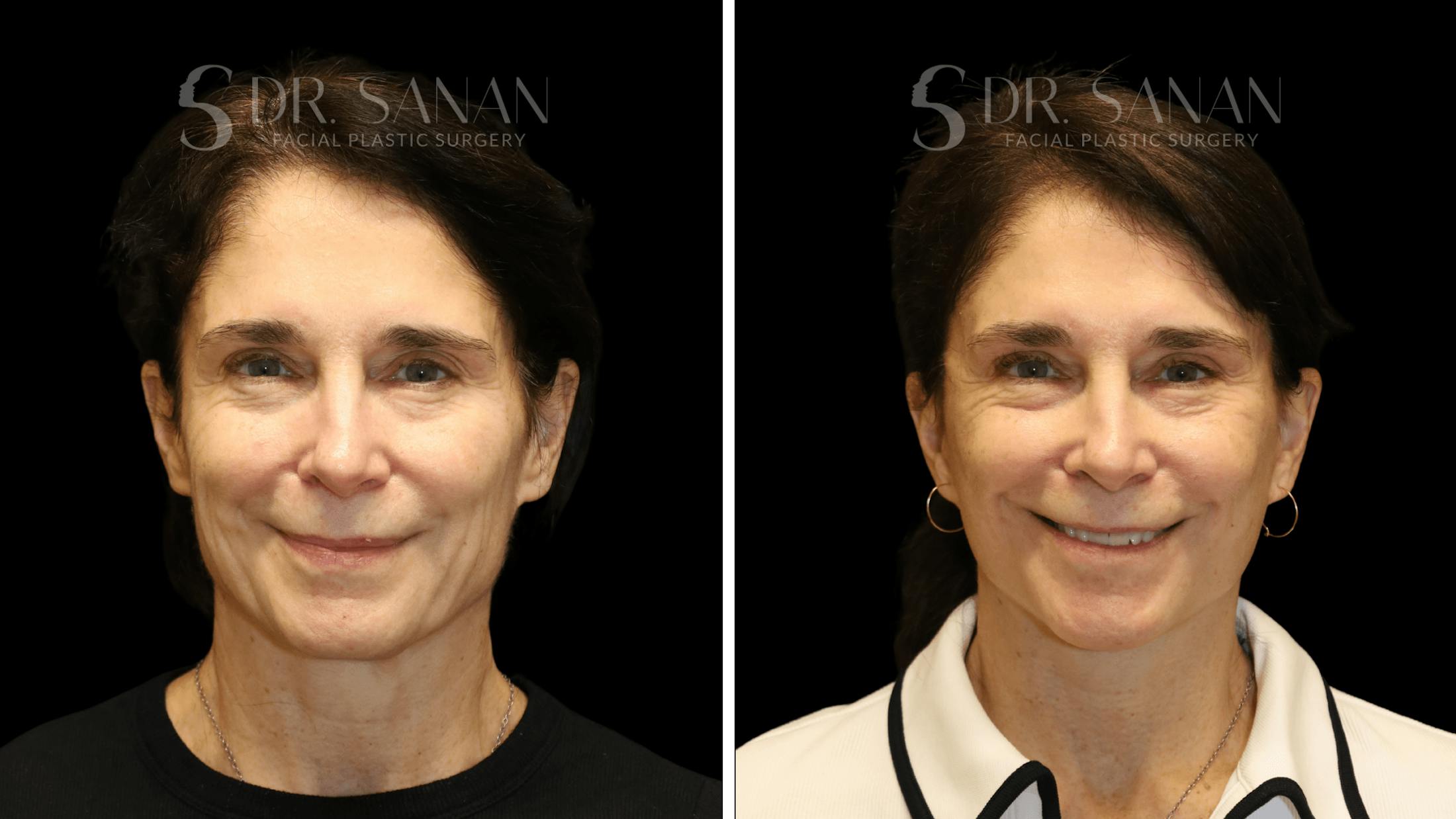 Brow Lift Before & After Gallery - Patient 422921 - Image 2