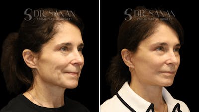 Deep Plane Facelift Before & After Gallery - Patient 385052 - Image 1