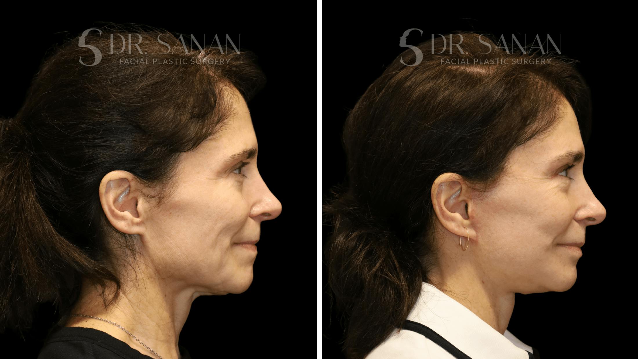 Brow Lift Before & After Gallery - Patient 422921 - Image 7