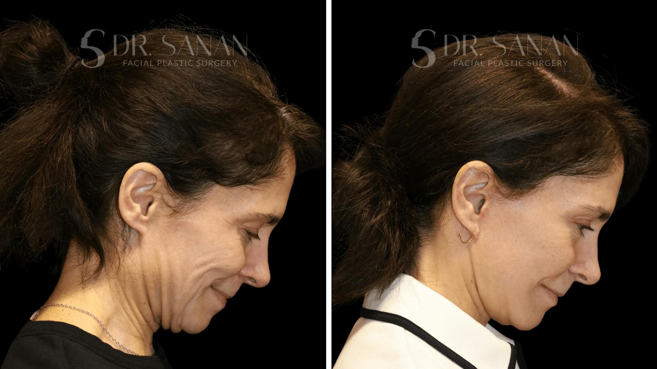 Brow Lift Before & After Gallery - Patient 422921 - Image 4