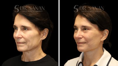 Deep Plane Facelift Before & After Gallery - Patient 385052 - Image 1