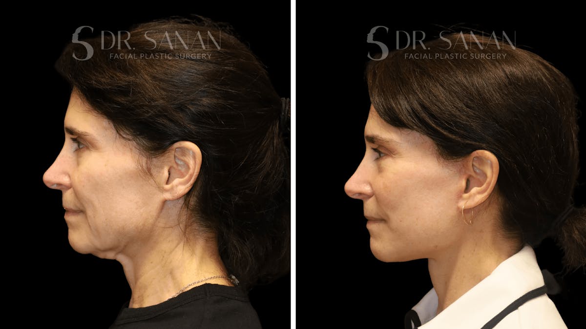 Brow Lift Before & After Gallery - Patient 422921 - Image 5